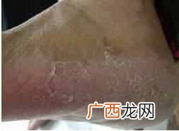 香港脚怎么治才能根除？教你一招彻底治疗