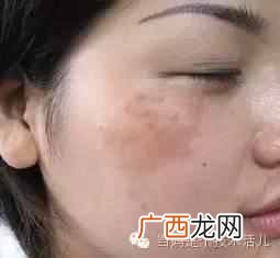 脸上长蝴蝶斑怎么办？引发蝴蝶斑的原因你知道