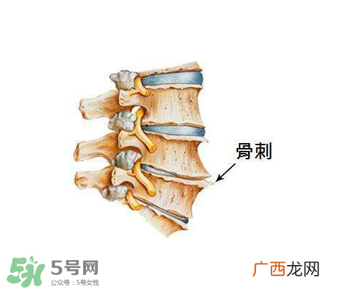 骨刺是怎么形成的？骨刺怎么治疗？