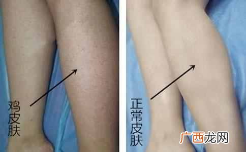 鸡皮肤怎么办？有效解决鸡皮肤困扰