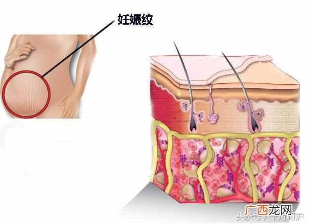 妊娠纹怎么办？10种方法，总有一种适合你