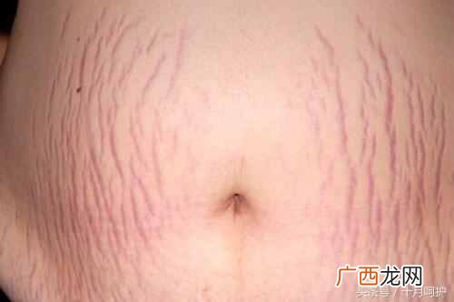 妊娠纹怎么办？10种方法，总有一种适合你