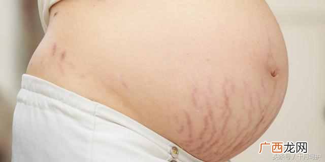 妊娠纹怎么办？10种方法，总有一种适合你