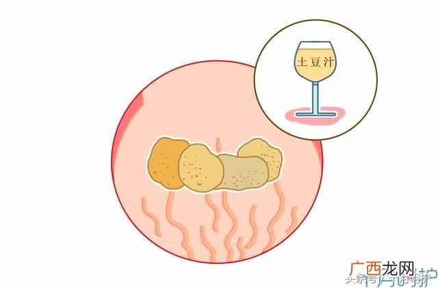 妊娠纹怎么办？10种方法，总有一种适合你