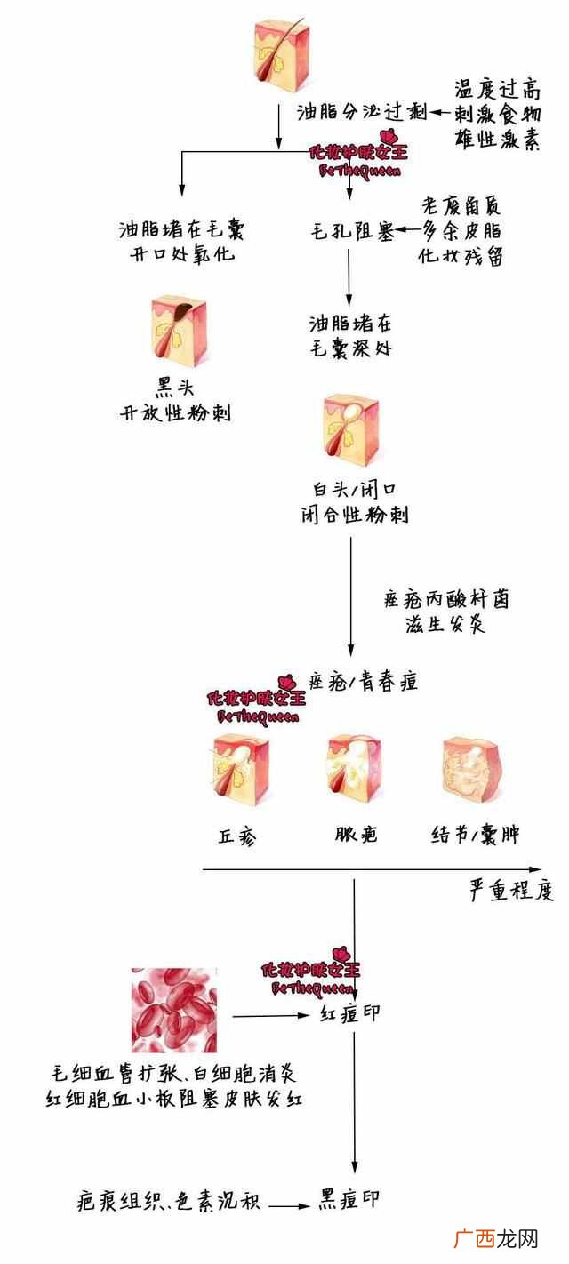 怎么样去痘和痘印？秘制配方去痘印效果没得说