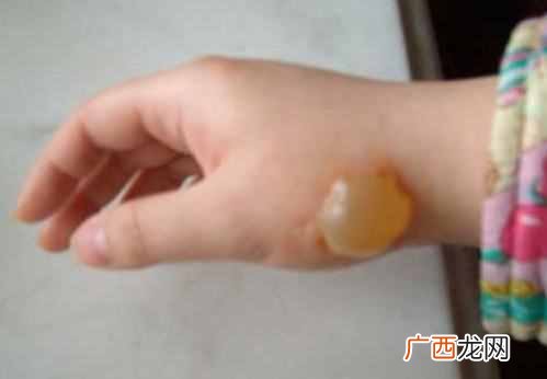 烫伤的水泡怎么处理？最正确的处理方法