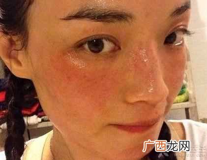 脸上有斑点怎么办？针对治疗，快速消除有方法