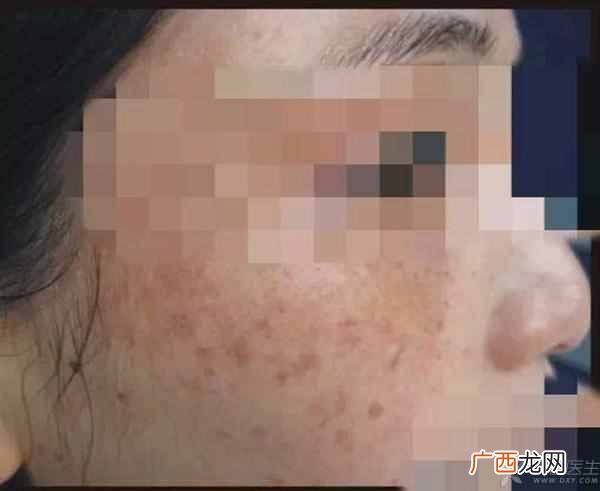 脸上有斑点怎么办？针对治疗，快速消除有方法