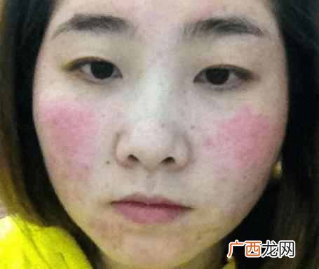 激素性皮炎怎么治疗？彻底治疗的方法