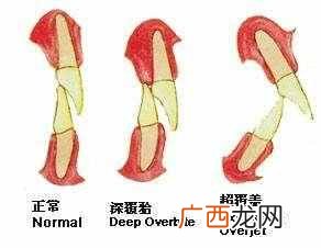龅牙怎么办？孩子龅牙的原因你知道么，从根源