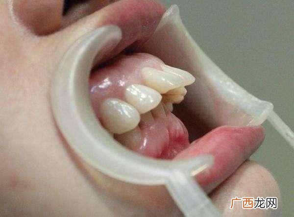 龅牙怎么办？孩子龅牙的原因你知道么，从根源