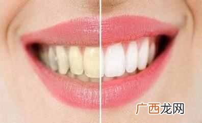 抽烟牙齿黄怎么变白？变白很简单，最省钱的方