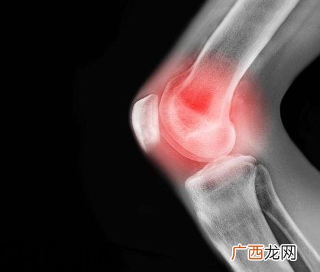 关节炎能吃螃蟹吗?关节炎能吃海鲜吗?