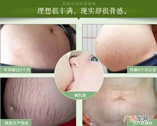 妊娠纹怎么预防？小妙招带你告别妊娠纹烦恼