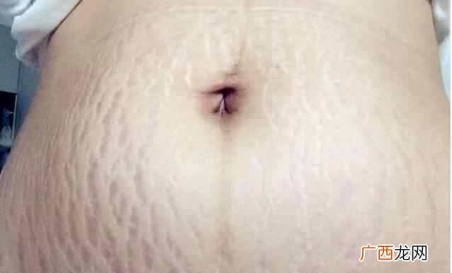 妊娠纹怎么预防？小妙招带你告别妊娠纹烦恼