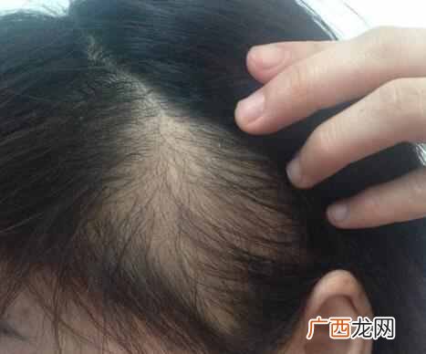 头发稀疏怎么办？6个妙招，没效果找我