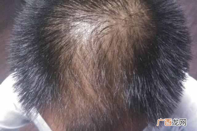 头发稀疏怎么办？6个妙招，没效果找我
