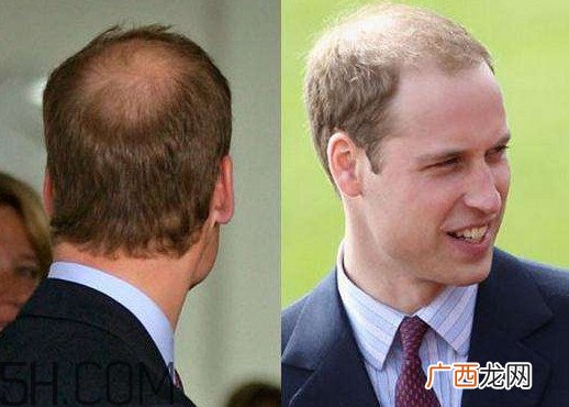 什么样的人容易秃顶？为什么女人不秃顶
