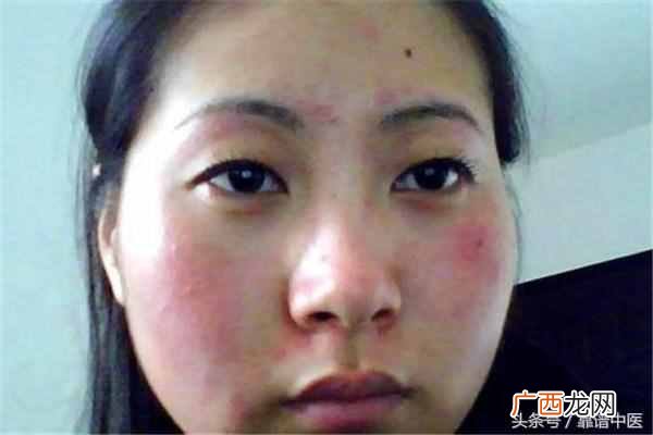 脸部过敏发红怎么办？教你一招告别过敏发红