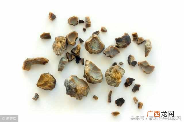 肾结石是怎么形成的？肾结石的3个原因