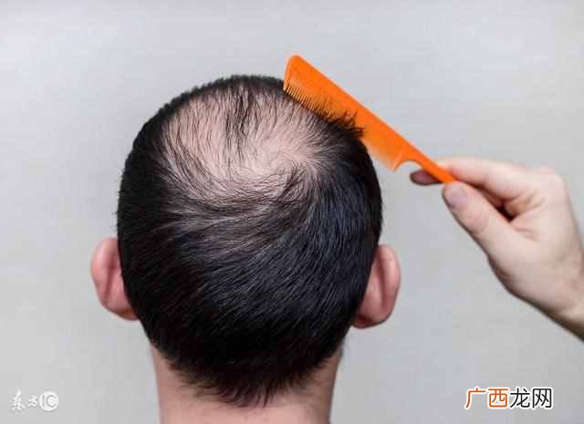 怎么治疗脱发最有效的方法？治疗脱发秘方