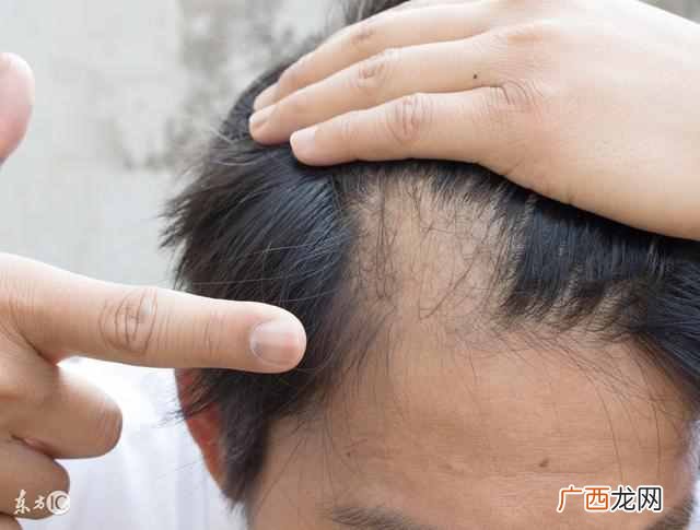 怎么治疗脱发最有效的方法？治疗脱发秘方