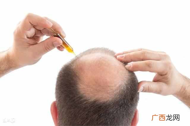 怎么治疗脱发最有效的方法？治疗脱发秘方