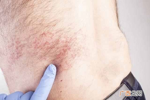 慢性湿疹怎么治？想要彻底根治还得用这个方法