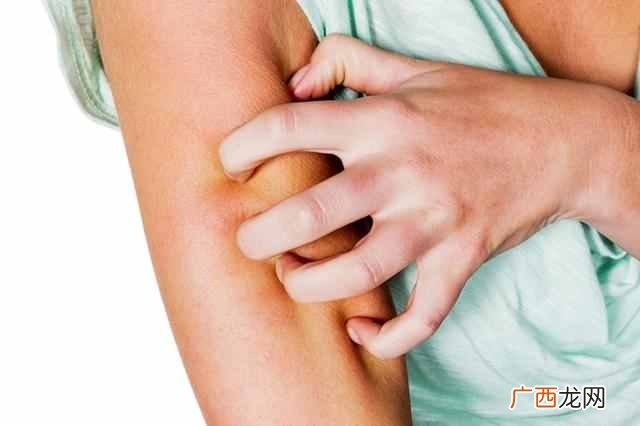 慢性湿疹怎么治？想要彻底根治还得用这个方法