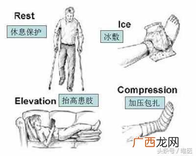 脚扭伤怎么处理？骨科医生教你正确的处理方法