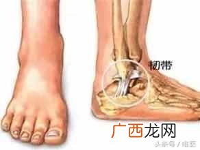 脚扭伤怎么处理？骨科医生教你正确的处理方法