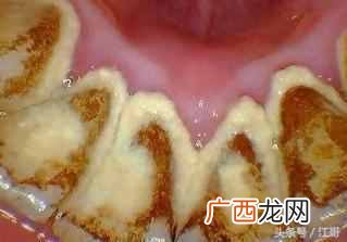 怎么去牙石？在家自己就能去牙石的方法（省钱