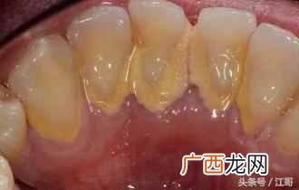 怎么去牙石？在家自己就能去牙石的方法（省钱