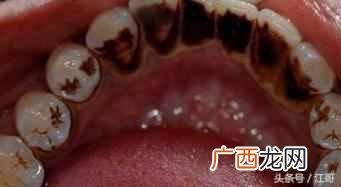 怎么去牙石？在家自己就能去牙石的方法（省钱