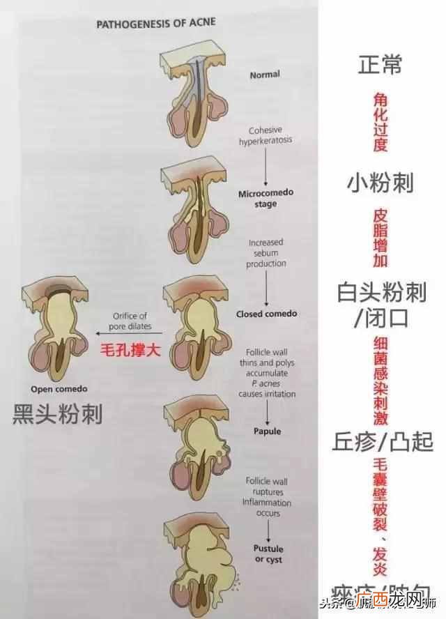 脸上长痘痘怎么办啊？祛痘有妙招，土方法太管