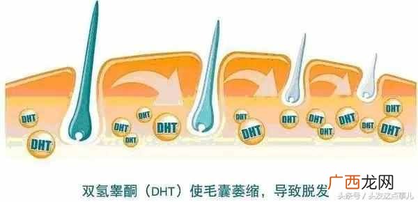 怎么治疗脂溢性脱发？根治的方法在这里