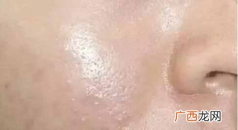 怎么去痤疮最好的方法？根治其实不难，方法对