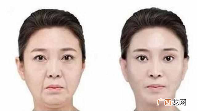 怎么样去除法令纹？去除有妙招，不试不知道