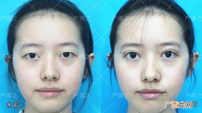 割双眼皮两边不一样宽怎么办，双眼皮失败该怎么修复