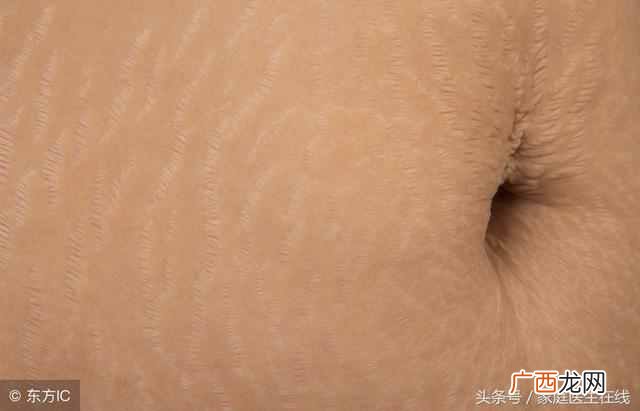 妊辰纹怎么去除的最好方法？效果居然这么好，