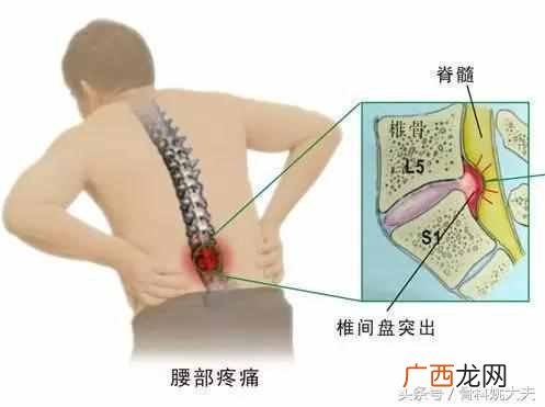 腰痛怎么办才好？几个动作快速解决腰痛困扰