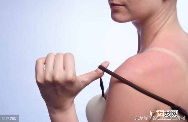 晒伤了怎么办?快速修复的7个方法,总有一个方