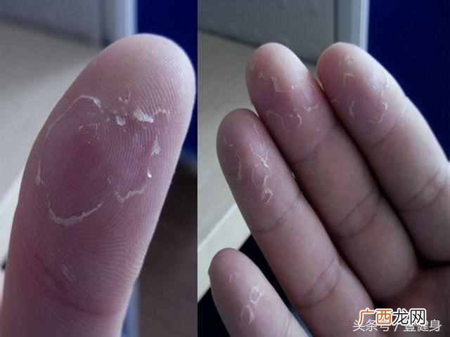 冬天小孩手指脱皮是怎么回事（可能是4种常见的