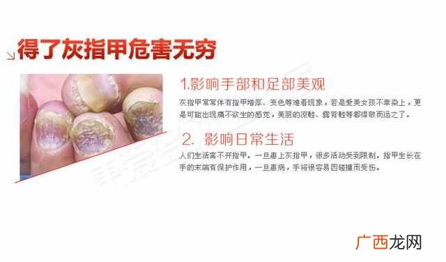 彻底除根的治疗方法 灰指甲怎么治好的快