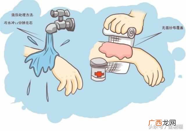一个小妙招轻松解决 手被开水烫了怎么办