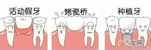 临时解决办法 大门牙掉了怎么办