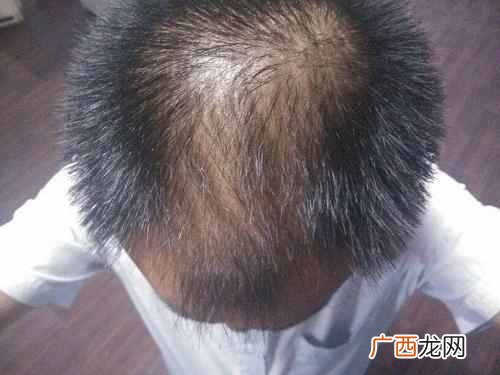 这几招很简单 女人头发稀少怎么变浓密