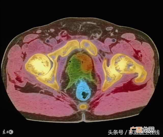 偶尔尿分叉是怎么回事（这是前列腺的症状吗？