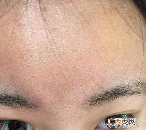 一个小窍门搞定 脸部毛孔堵塞怎么办