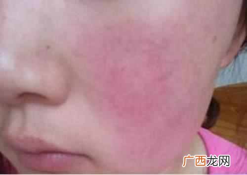 怎么去除红血丝(消除红血丝最好的办法及保养